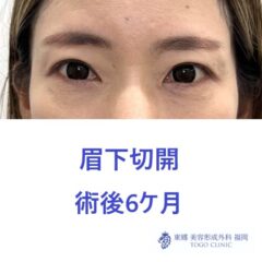ﾊﾗﾉﾔｽｺ　眉下6M - コピー