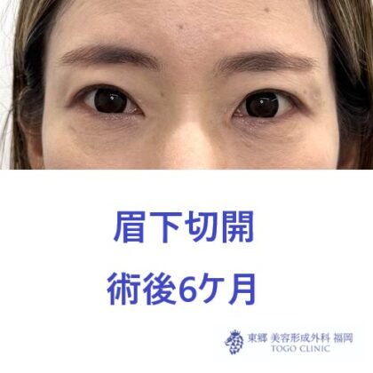 ﾊﾗﾉﾔｽｺ　眉下6M - コピー