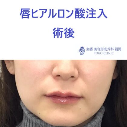 くちびる　術後_R