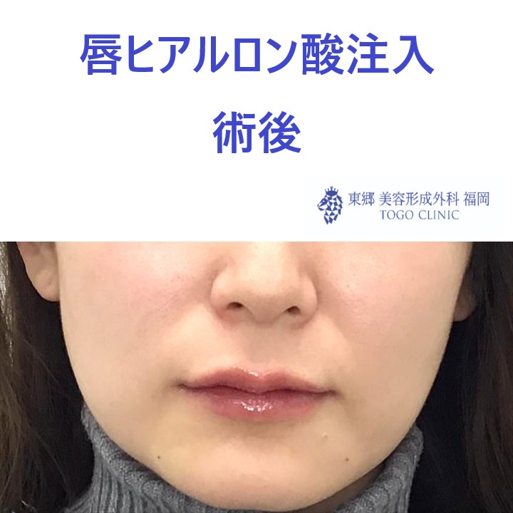 くちびる　術後_R