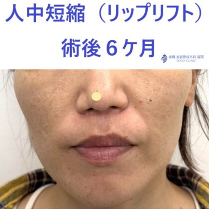 ｵｵﾂｶﾏﾄﾞｶ術後６M