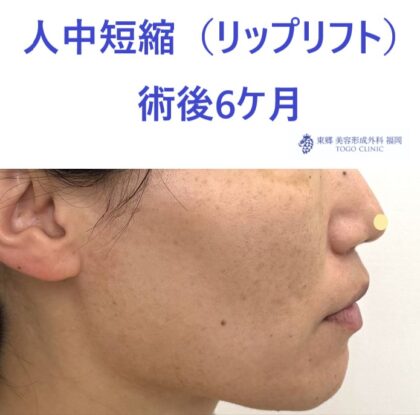 ｵｵﾂｶﾏﾄﾞｶ術後6M (2)