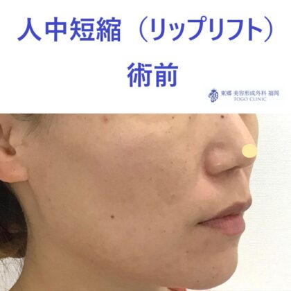 ｵｵﾂｶﾏﾄﾞｶ　術前