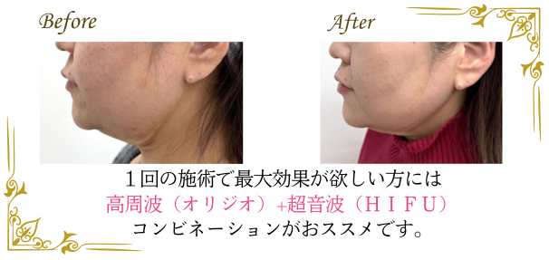 ハイフとオリジオの組み合わせで最強のたるみ治療