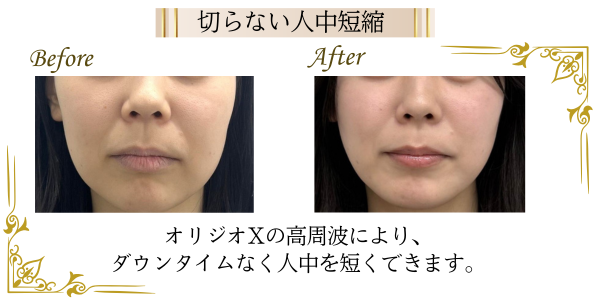 オリジオによる、切らない人中短縮