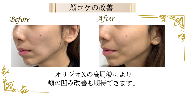オリジオによる、頬の凹みの改善