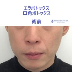 ﾀﾊﾗﾉﾌﾞﾋﾛ術前
