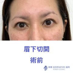 術前