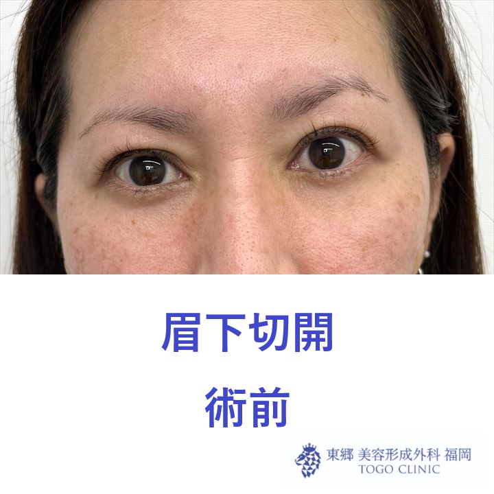 術前