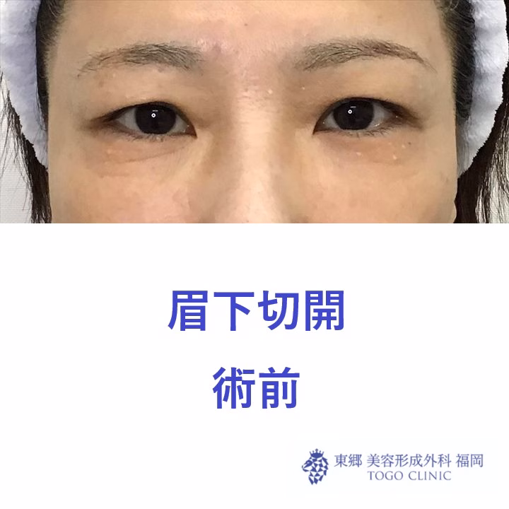 術前