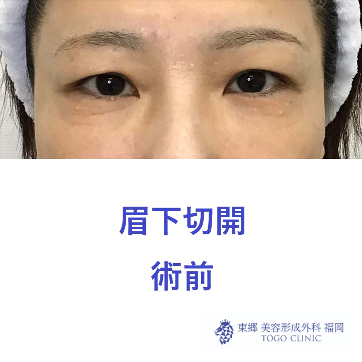 術前
