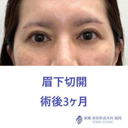 術後３M