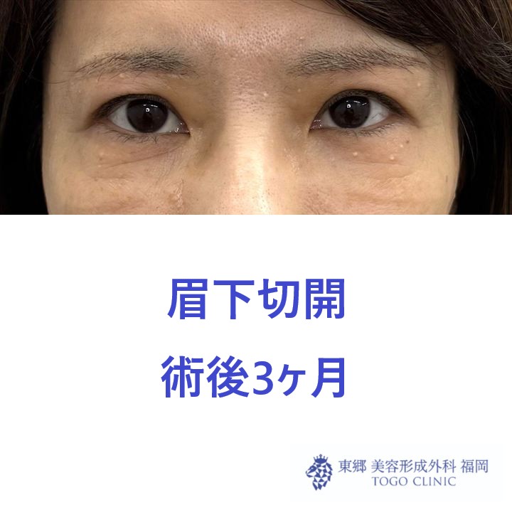術後
