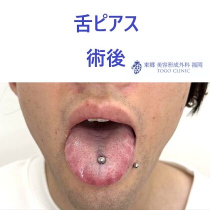 ｳﾙｼﾀﾞﾆｾﾅ　術後 (2)