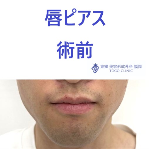 ｳﾙｼﾀﾞﾆｾﾅ　術前