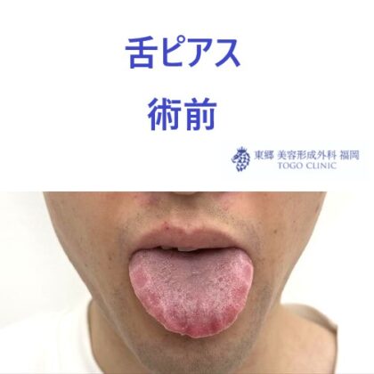 ｳﾙｼﾀﾞﾆｾﾅ　術前 (2)