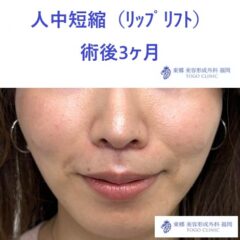 リップリフト　福岡