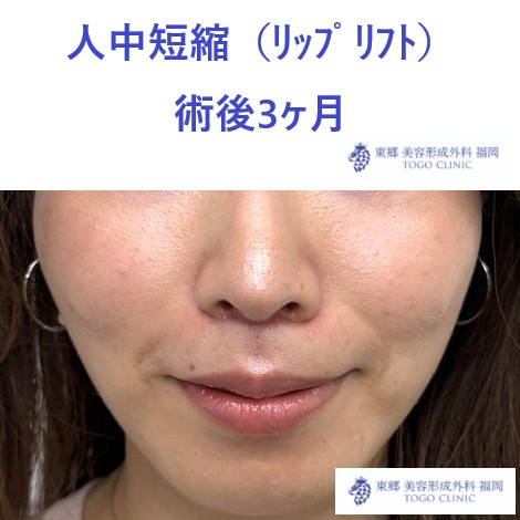 リップリフト　福岡