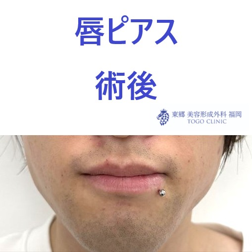 ｳﾙｼﾀﾞﾆｾﾅ　術後