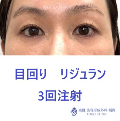 リジュラン術後