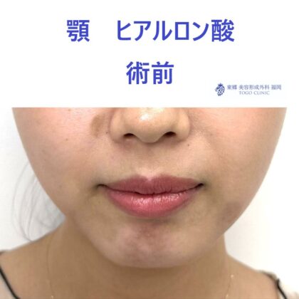 ｸﾜﾊﾗｲｱｲﾈ　あご　術前