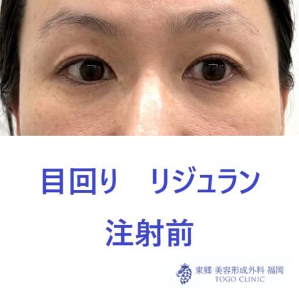 ﾌﾙｶﾜｻﾁｺ　リジュラン術前
