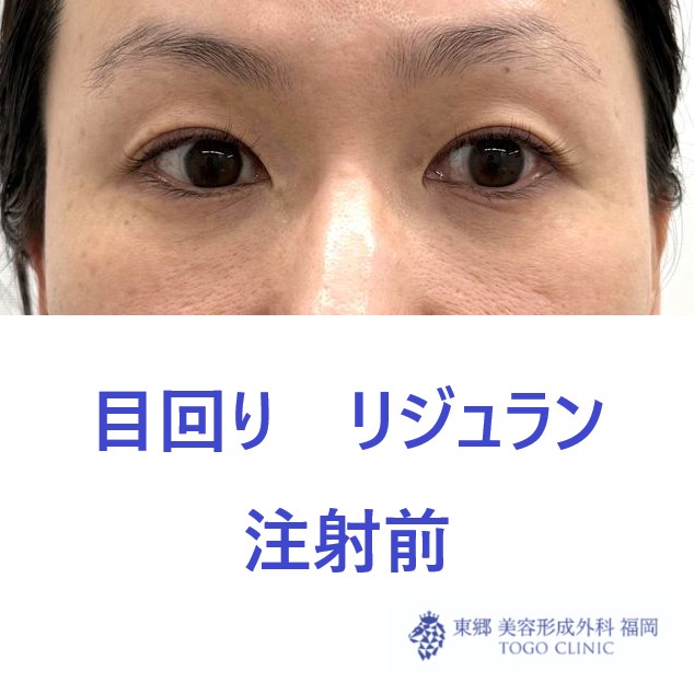 ﾌﾙｶﾜｻﾁｺ　リジュラン術前