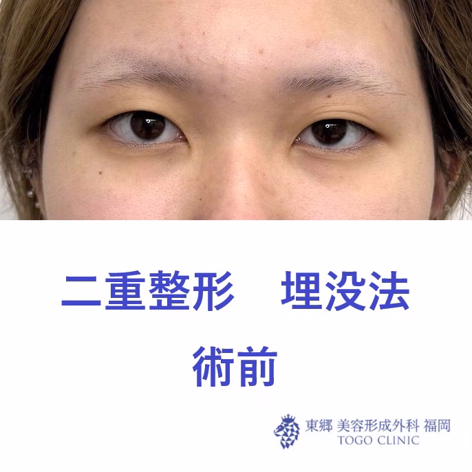 ﾔﾏﾈｷﾞﾅﾂ術前