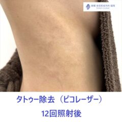 平佐千夏　10回照射後_R