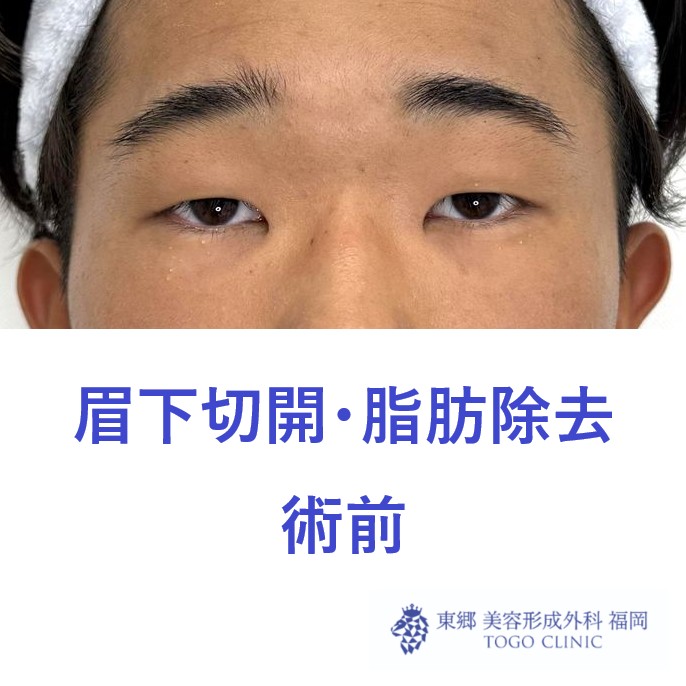 ﾆｼｸﾞﾁｺｳ　術前