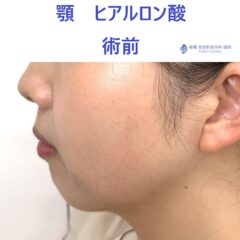 ｸﾜﾊﾗｲｱｲﾈ　あご　術前 (2)