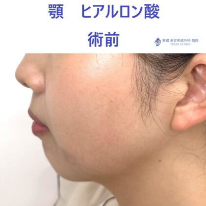 ｸﾜﾊﾗｲｱｲﾈ　あご　術前 (2)