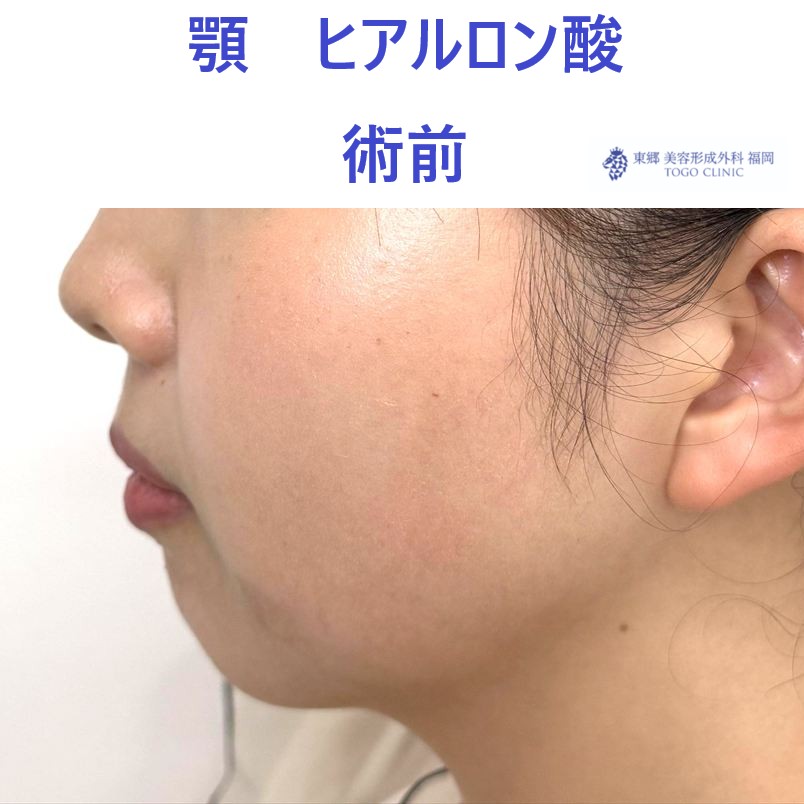 ｸﾜﾊﾗｲｱｲﾈ　あご　術前 (2)
