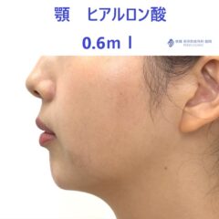 ｸﾜﾊﾗｲｱｲﾈ　あご　術後 (2)