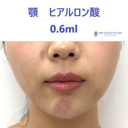 ｸﾜﾊﾗｲｱｲﾈ　あご　術後