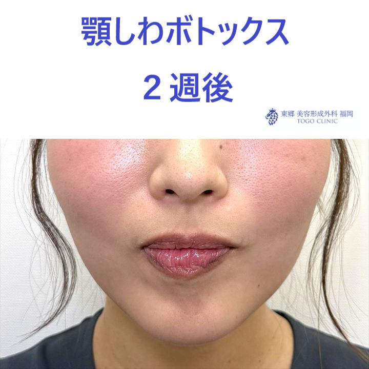 SK　顎Bt術後