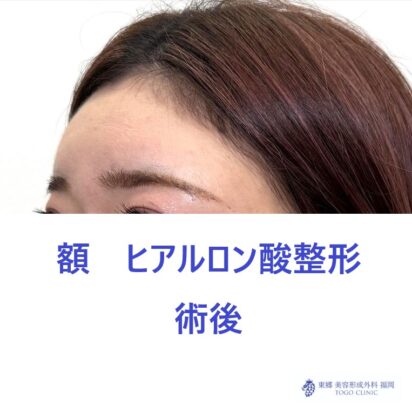 RH　額HA術後 (3)