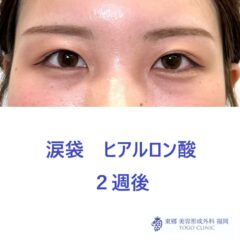 SK　涙袋術後