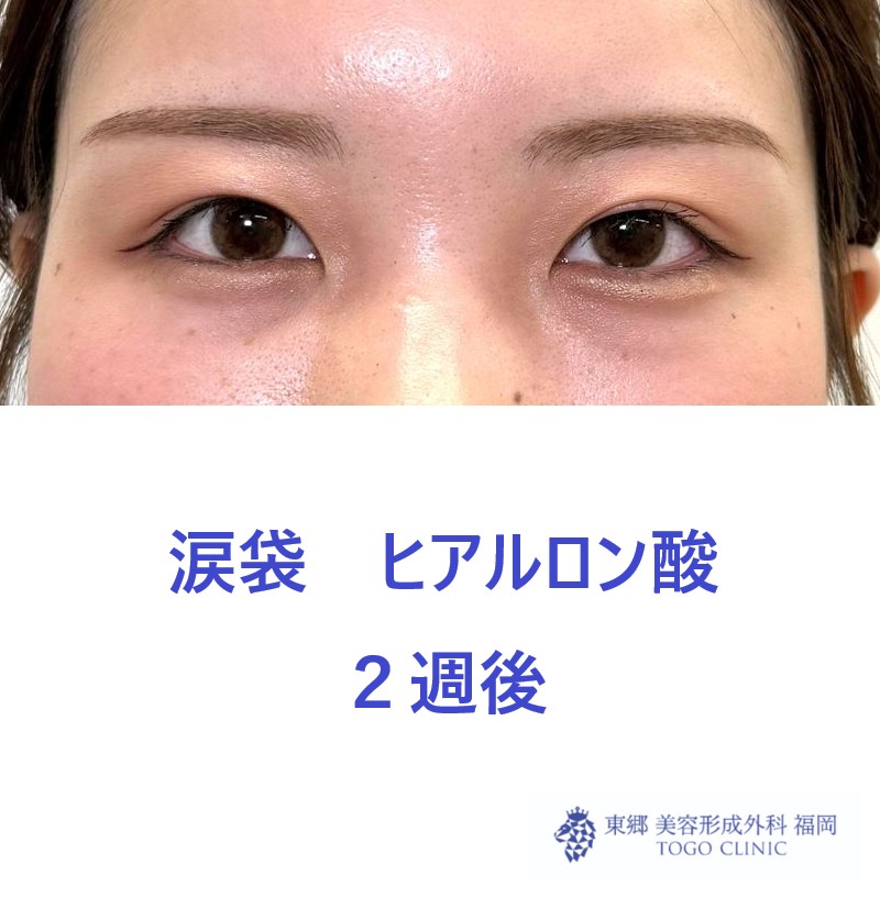 SK　涙袋術後