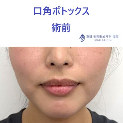 口角術前