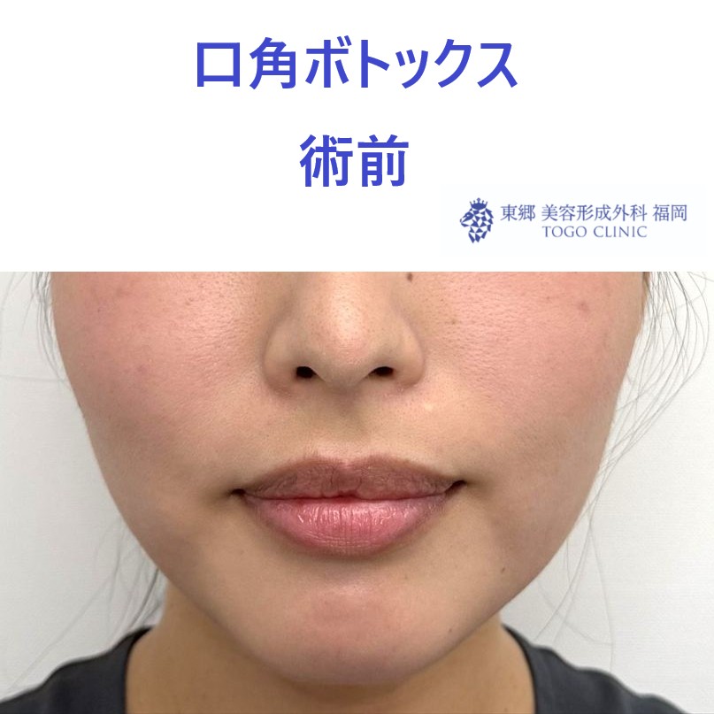 口角術前