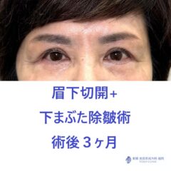 MT　眉下+下たるみ術後