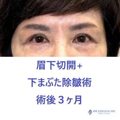 MT　眉下+下たるみ術後