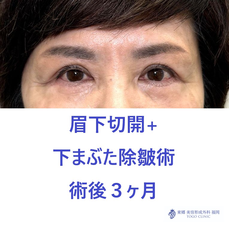 MT　眉下+下たるみ術後