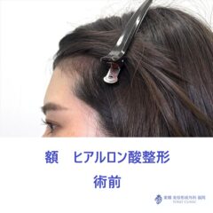 額HA術前 (2)_R