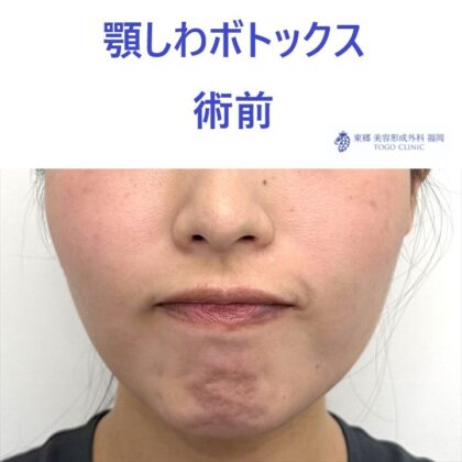 SK 顎Btx　術前