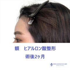 額HA術後 (2)_R