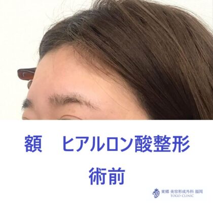 RH　額HA術前 (3)