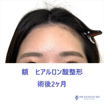 額HA術後_R