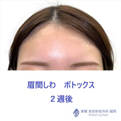 SK　眉間Btx術後